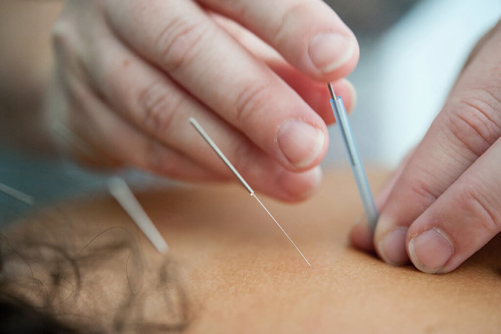 Closeup of a person receiving acupuncture